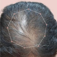 Month 1 Hair Progress