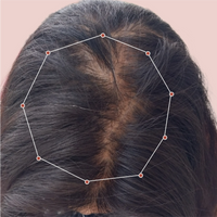 Month 1 Hair Progress