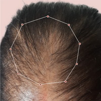 Month 1 Hair Progress