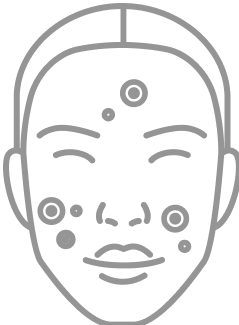 Acne Breakouts