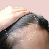 Month 1 Hair Progress