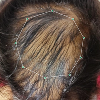 Month 1 Hair Progress