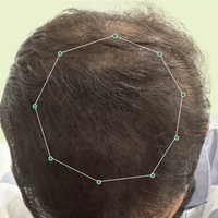 Month 1 Hair Progress