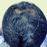 Month 1 Hair Progress