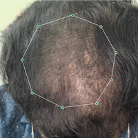 Month 1 Hair Progress