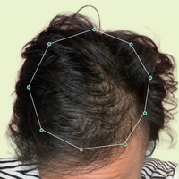 Month 1 Hair Progress