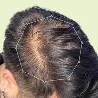Month 1 Hair Progress