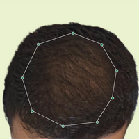 Month 1 Hair Progress