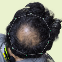 Month 1 Hair Progress