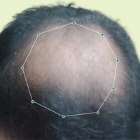 Month 1 Hair Progress
