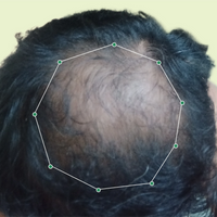 Month 1 Hair Progress
