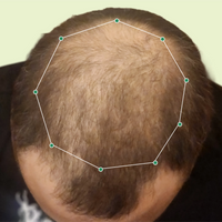 Month 1 Hair Progress