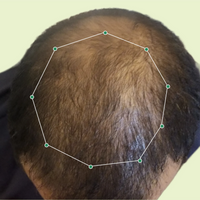 Month 1 Hair Progress