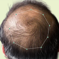 Month 1 Hair Progress