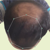 Month 1 Hair Progress