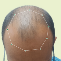 Month 1 Hair Progress