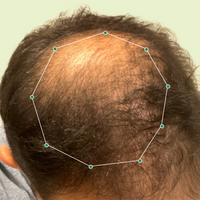 Month 1 Hair Progress
