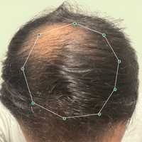 Month 1 Hair Progress