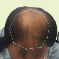 Month 1 Hair Progress