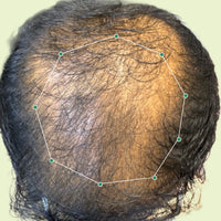Month 1 Hair Progress