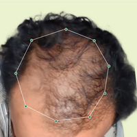 Month 1 Hair Progress