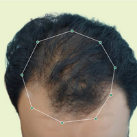 Month 1 Hair Progress