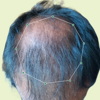 Month 1 Hair Progress